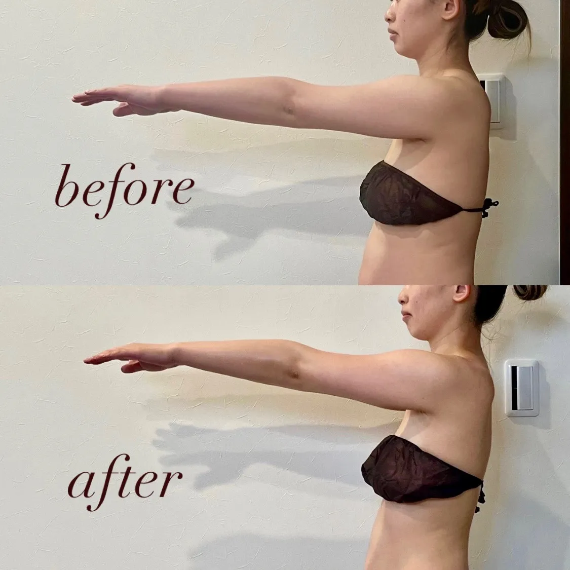 滋賀県で理想の二の腕を！ブライダルエステで美しく